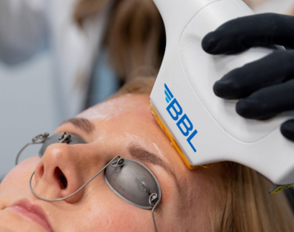 woman getting BBL Laser treatment
