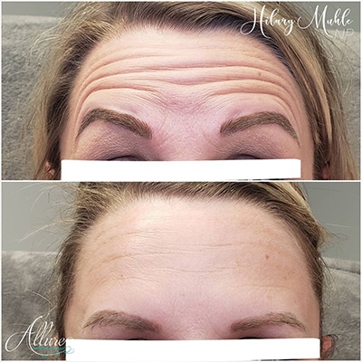 Botox Before & After Frown Lines
