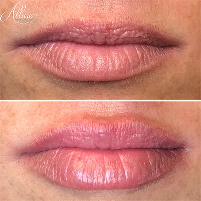 Demi Lip Plump Juvederm Allure Health and Med Spa