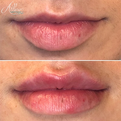 Demi Lip Plump Juvederm Allure Health and Med Spa