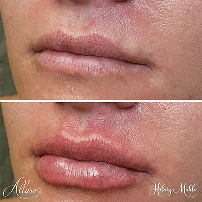 Lux Lip Plump Juvederm Allure Health and Med Spa