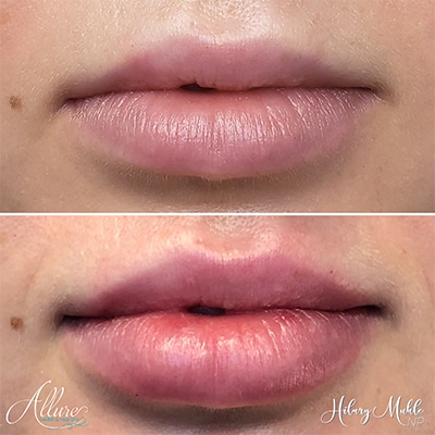 Lux Lip Plump Juvederm Allure Health and Med Spa