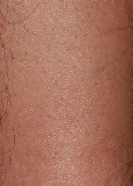 BBL Laser hair removal in Omaha