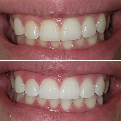 Sinsational Teeth whitening
