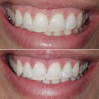 Sinsational Teeth whitening Allure Med Spa Omaha