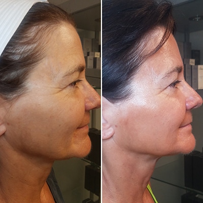 Micro-current Facial Rejuvenation Before and After Omaha