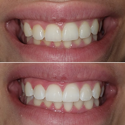 Teeth whitening Allure Med Spa Omaha